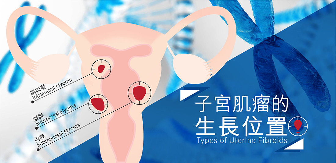 子宮肌瘤